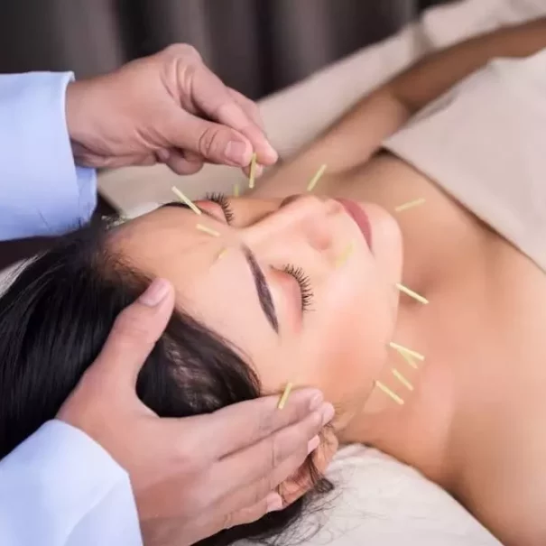 What is Facial Rejuvenation Acupuncture