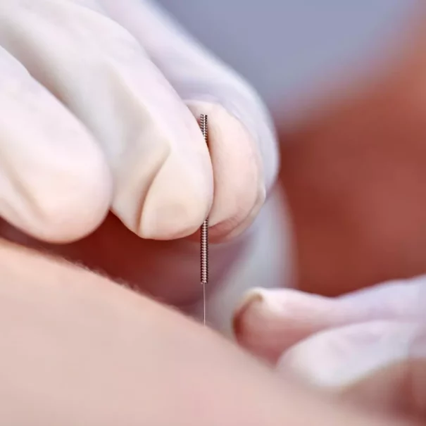 Dry needling