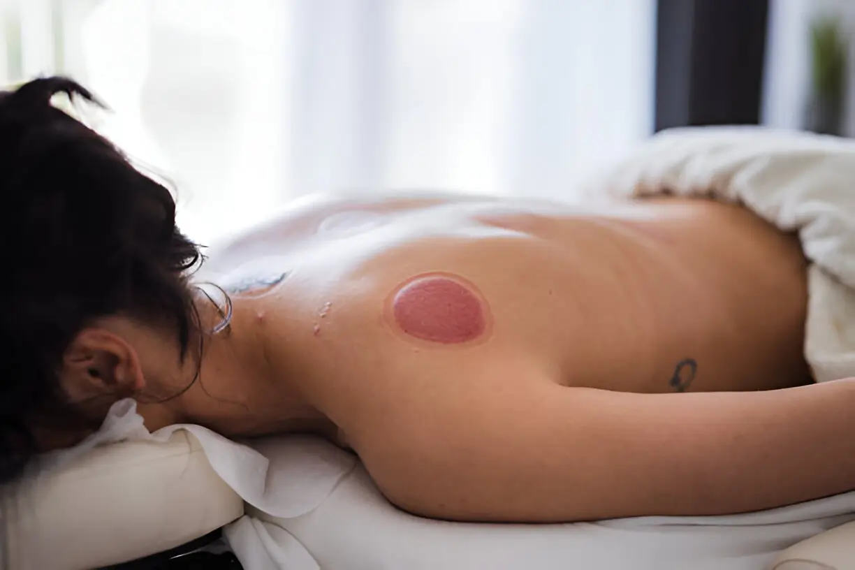 How Does Cupping Help Athletes