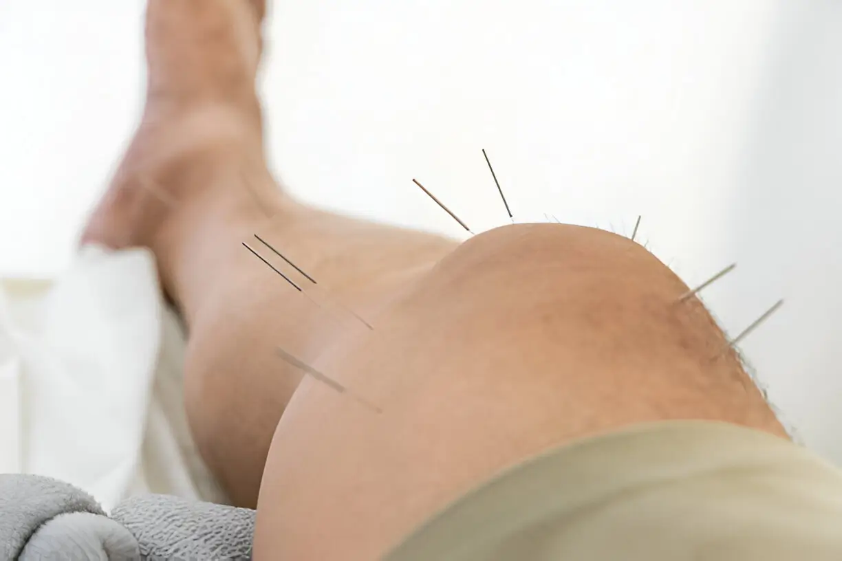 Acupuncture for addiction